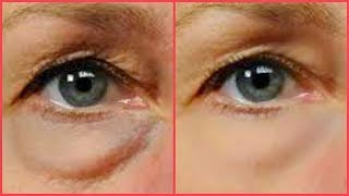 2 STEPS TO GET RID OF PUFFY EYES DRY UNDER EYES EYE BAGS AND DARK CIRCLES Khichi Beauty [upl. by Nana381]