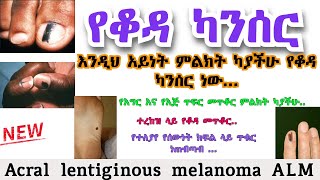 Acral lentiginous melanoma ALM  የቆዳ ካንሰር  የጤና ቃል [upl. by Glantz295]