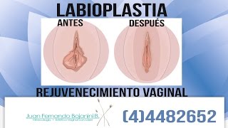 Rejuvenecimiento Vaginal en Medellín  Labioplastia  Dr Juan Fernando Bojanini [upl. by Chaddy508]