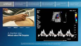 Advanced screening views of the fetal heart  Part 1  4chamber color and PW Doppler [upl. by Camilo950]