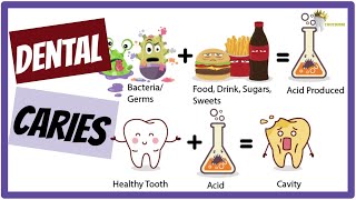 DENTAL CARIES Etiology Keyes Jordan diagram Stephans Curve SIMPLIFIED [upl. by Egiedan]