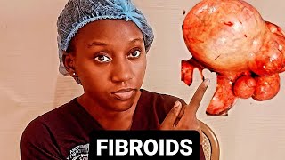 FIBROIDS What is the Cause Tell Signs Medication Options Available amp When to Opt for Surgery [upl. by Alroi689]