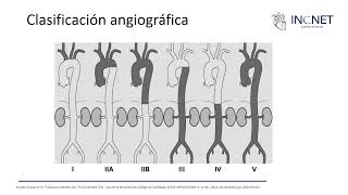 Arteritis de Takayasu [upl. by Sheryl]