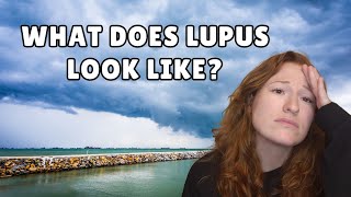 Lupus Flare Up Symptoms My Lupus Story [upl. by Savina]