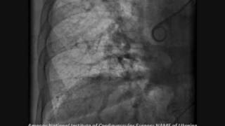 Pulmonary Embolism Cath Lab  Successful Thrombolytic Therapy [upl. by Enimassej]