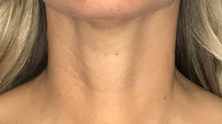 Scarless Thyroidectomy  Transoral Endoscopic Thyroidectomy Vestibular Approach [upl. by Arten]