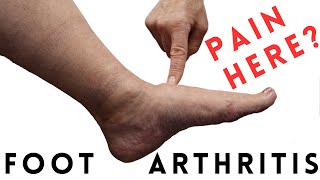 Foot Arthritis Pain Most Common Signs and Symptoms [upl. by Hapte]