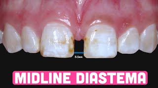 Midline diastema  Etiology amp Treatment options [upl. by Holland606]