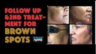 Laser treatment for brown spots part 2 [upl. by Hutchings]