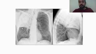 daily tip 4 lobar pneumonia [upl. by Anemix]