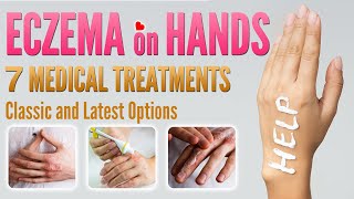 Eczema on Hands Treatment  7 Best Medical Treatment Options for Hand Dermatitis [upl. by Rheinlander]