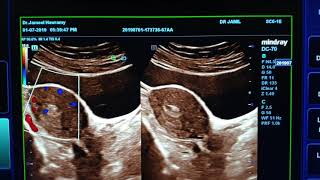 Endometrial Polyp Sonography [upl. by Nilrem427]