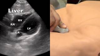 Subcostal or Subxiphoid Ultrasound Evaluation [upl. by Aenal]