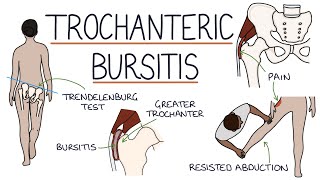 Understanding Trochanteric Bursitis [upl. by Gregrory]