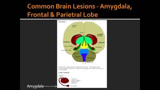 Common Brain Lesions  Amygdala Frontal amp Parietral Lobe [upl. by Anson32]