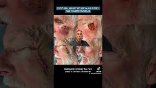 MALIGNANT MELANOMA SURGERY AND RECONSTRUCTION [upl. by Airotna]