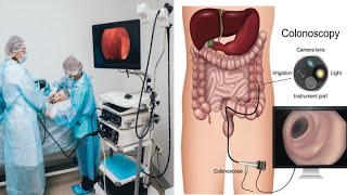 COMBINED GASTROSCOPY amp COLONOSCOPY [upl. by Gnot]