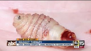 Medical maggots used in Valley hospital [upl. by Hctub]