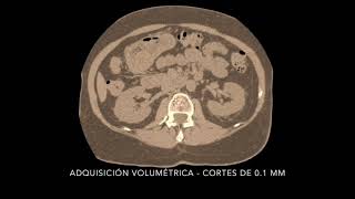 Osirix MD Tomografía de columna lumbar [upl. by Ameehs427]