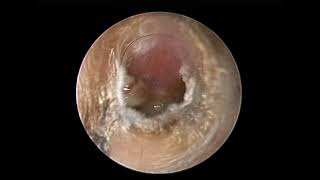 Boil in the ear  Circumscribed Otitis Externa  Dr K R Meghanadh  Medyblog [upl. by Aggri]