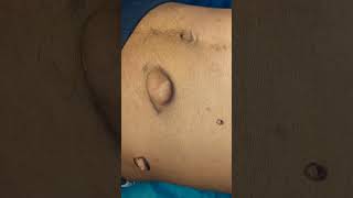 Neurofibroma treatment in Bangladesh [upl. by Melbourne]