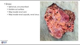 Kidney Renal cell carcinoma Microscopy  Talking slide [upl. by Tnahsin]