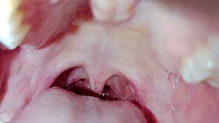 Tonsil Stone  Batu Tonsil  Batu Amandel [upl. by Goulder]