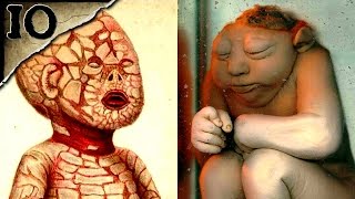 10 Horrible Birth Defects  TWISTED TENS 17 [upl. by Tebzil]