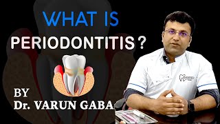 Periodontitis  Gum Disease  Pyria  Symptoms amp Treatment  Star Imaging amp Path Lab Dr Varun Gaba [upl. by Yregerg]