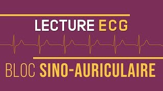 Interprétation ECG  Bloc SinoAuriculaire [upl. by Jane]