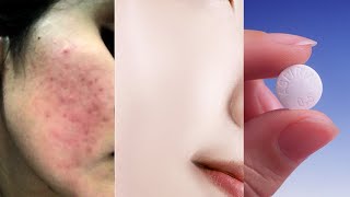 How to use disprin tablet for skin  Disprin tablet for pimples and Antiacne as skin care [upl. by Yttiy]