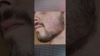 1 ANO E 6 MESES usando Minoxidil minoxidil foligain evolução minoxidil barba barbearia [upl. by Hoenack]