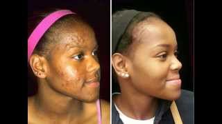 Acne Care for Black Skin  Before amp After Images [upl. by Oel]