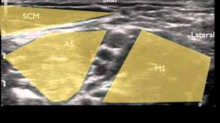 Ultrasound Guided Interscalene Nerve Block [upl. by Zurek]