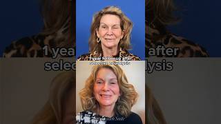 1 year follow up after selective neurolysis facialparalysis synkinesis acousticneuroma [upl. by Yrffej]