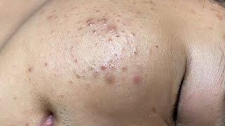 ACNE TREATMENT VU QUYNH MI  Perennial Blackheads On Boy Face 2024FULL [upl. by Grearson]