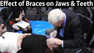 How Do Orthodontic Braces Change Upper amp Lower Jaws Position amp Teeth Misalignment by Prof John Mew [upl. by Adallard]