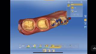 CEREC Crowns 3031 Inlay 29 [upl. by Anec]