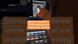 sténose carotidienne serrée traitée par une angioplastie stenting [upl. by Meredithe407]