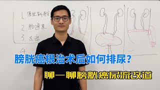 膀胱癌根治术后没有了膀胱，该如何排尿？ [upl. by Ingelbert]