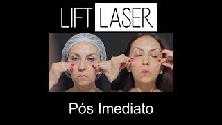 Antes e Depois do Endolaser Facial [upl. by Norra]