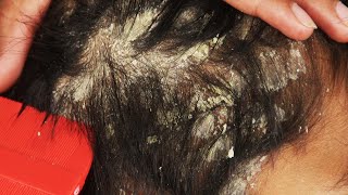 Dandruff scratching removal on head using black combing36 [upl. by Avehstab]