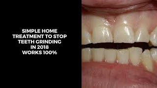 5 ultimate home treatment to stop jaw clenching grinding teeth in sleepbruxism cureteeth grinding [upl. by Annenn]