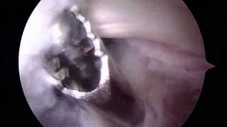 Arthroscopic Removal of Bakers Cyst  ORV  Raymond Whitehead MD [upl. by Armillas455]