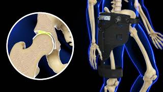 DonJoy EXCYABIR Hip Brace How it Works  Hip OA [upl. by Odlanir]