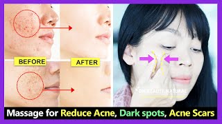 How to get rid of acne reduce open pores remove acne scars and dark spots with Face massage [upl. by Ancel986]