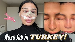 Rhinoplasty inTurkey [upl. by Prima]