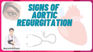 Peripheral Signs Of Aortic Regurgitation acein60sec clinical [upl. by Notyap]