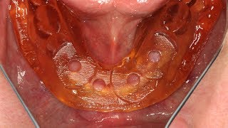 LODI Implant Placement Using an InOffice 3D Printed LODI Surgical Guide [upl. by Honey]