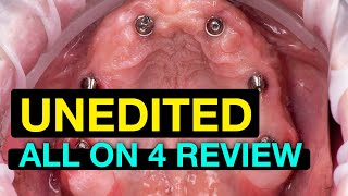 UNEDITED Allon4 Dental Implant Review [upl. by Browne]